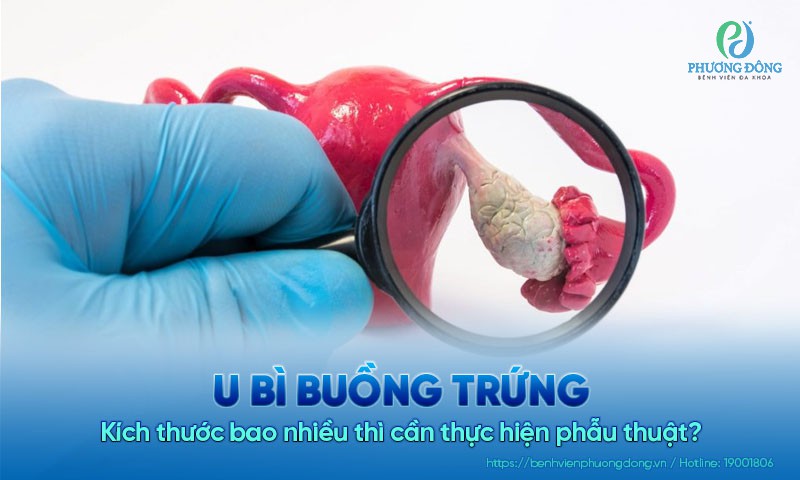 U bì buồng trứng kích thước bao nhiêu thì mổ? Các thông tin cần biết!