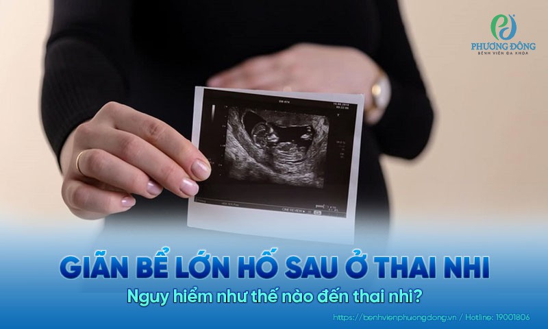 Giãn bể lớn hố sau ở thai nhi là gì? Gây nguy hiểm như thế nào đến trẻ?