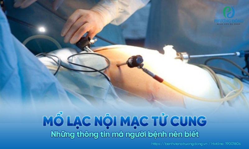 Mổ lạc nội mạc tử cung - Những thông tin mà người bệnh nên biết