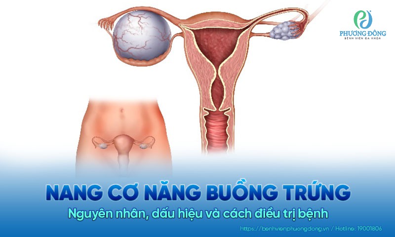 Nang cơ năng buồng trứng: Nguyên nhân, dấu hiệu và cách điều trị