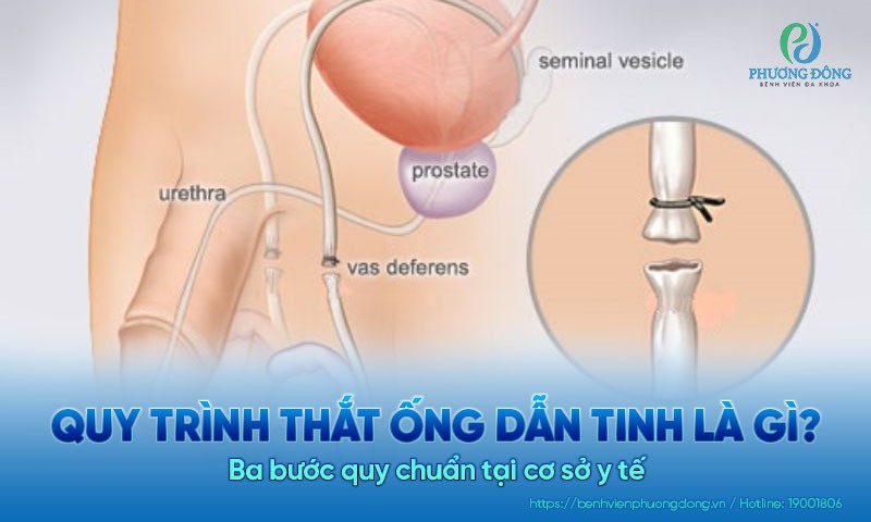 Quy trình thắt ống dẫn tinh là gì? Ba bước quy chuẩn tại cơ sở y tế