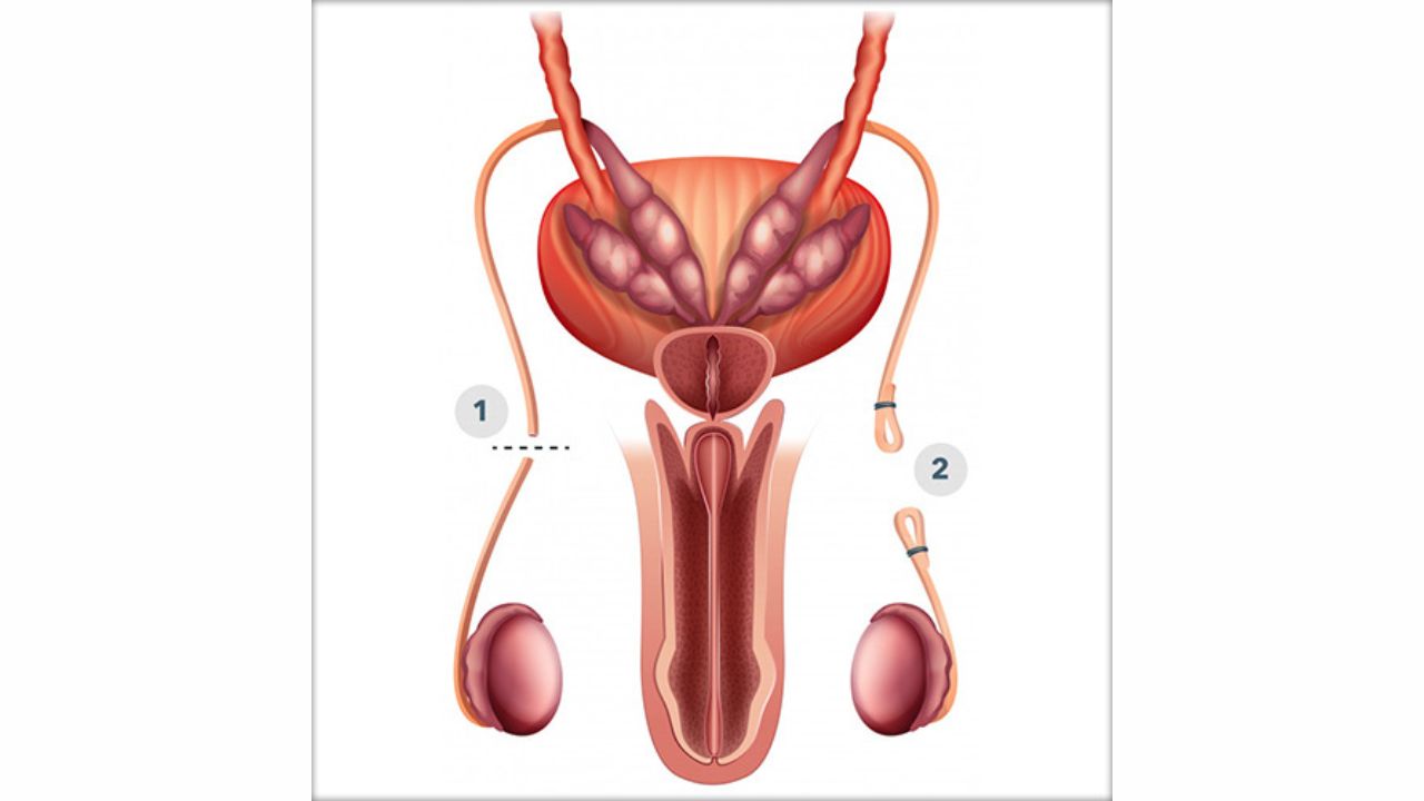 (Sau thủ thuật đường di chuyển bị bịt kín khiến tinh trùng ở lại trong ống dẫn tinh)