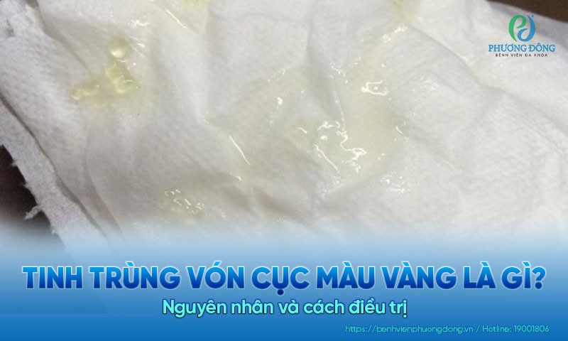 Tinh trùng vón cục màu vàng là gì? Nguyên nhân và cách điều trị