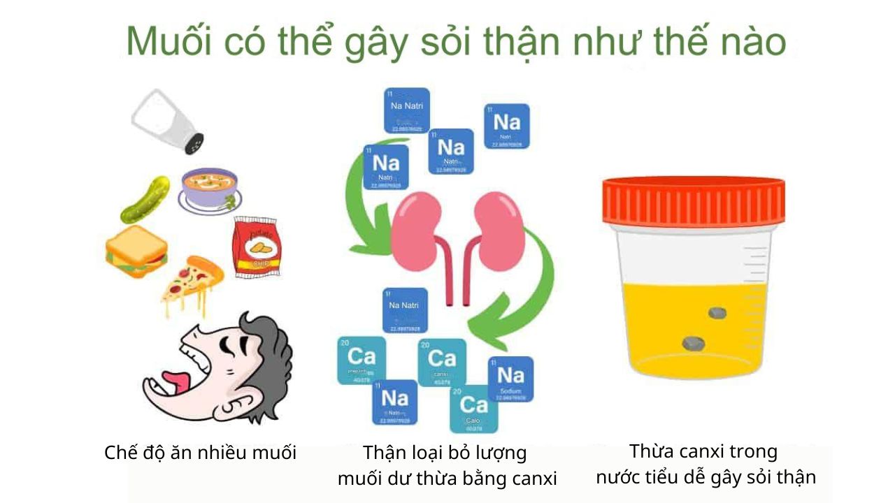 Sự ảnh hưởng của thói quen ăn mặn đến sự hình thành sỏi trong thận