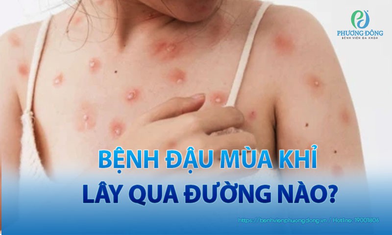 Giải đáp thắc mắc: Bệnh đậu mùa khỉ lây qua đường nào?