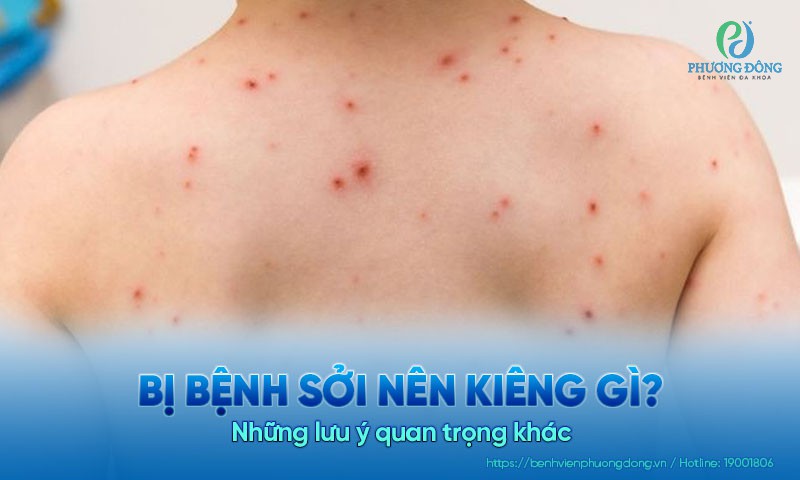 Bị bệnh sởi nên kiêng gì? Nên làm gì? Và những lưu ý quan trọng khác