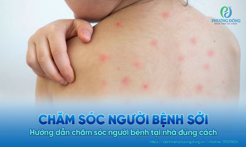 Hướng dẫn chăm sóc người bệnh sởi tại nhà đúng cách