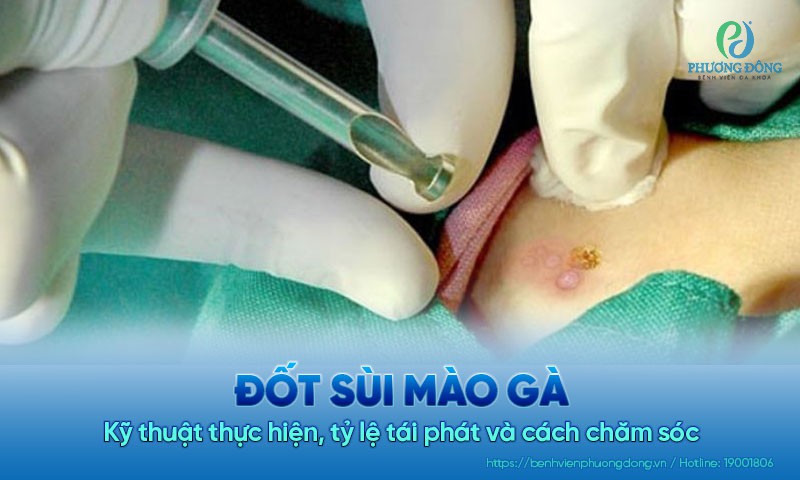 Đốt sùi mào gà: Kỹ thuật thực hiện, tỷ lệ tái phát và cách chăm sóc