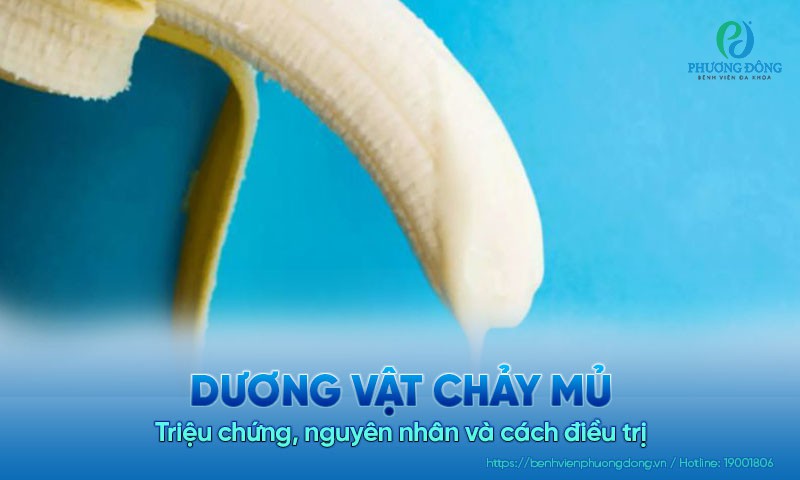 Dương vật chảy mủ: Triệu chứng, nguyên nhân và cách điều trị