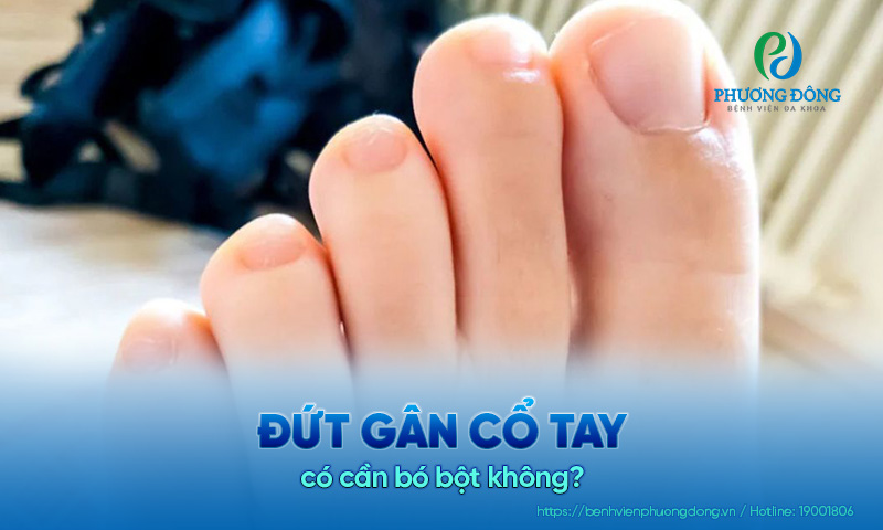 Bệnh nhân hỏi: Gãy ngón chân út có cần bó bột không?