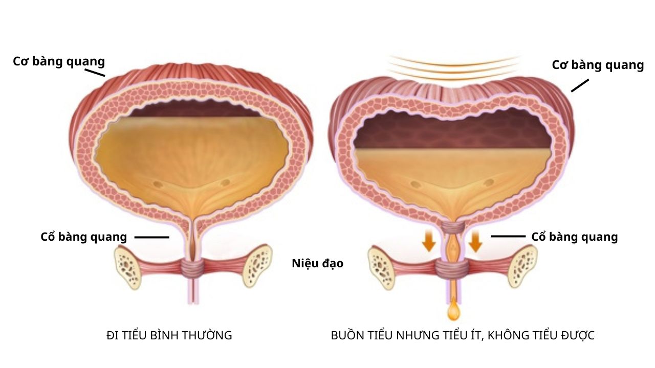 Minh hoạ về bàng quang khi đi tiểu