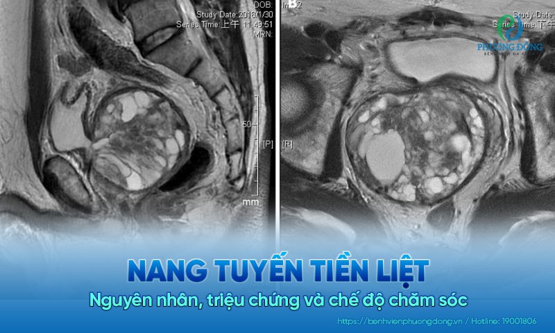 Nang tuyến tiền liệt: Nguyên nhân, triệu chứng và chế độ chăm sóc