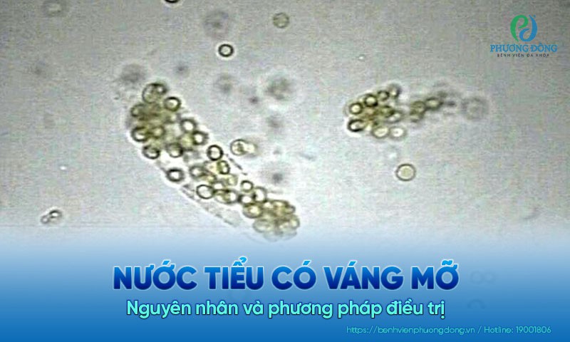 Nước tiểu có váng mỡ: Nguyên nhân và phương pháp điều trị