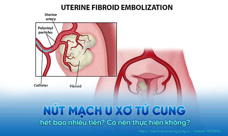 Nút mạch u xơ tử cung hết bao nhiêu tiền? Có nên thực hiện không?