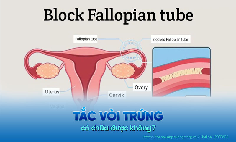 Tắc vòi trứng có chữa được không?