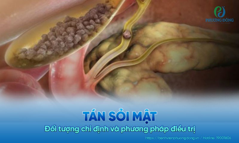 Tán sỏi mật: Đối tượng chỉ định và phương pháp điều trị