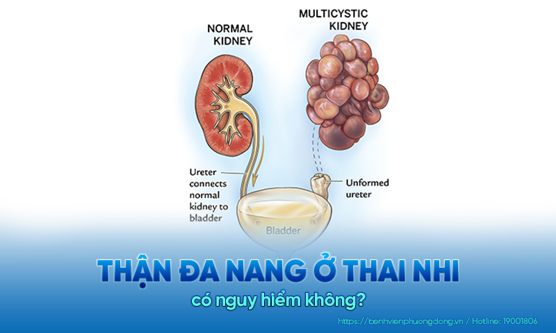 Thận đa nang ở thai nhi có nguy hiểm không?