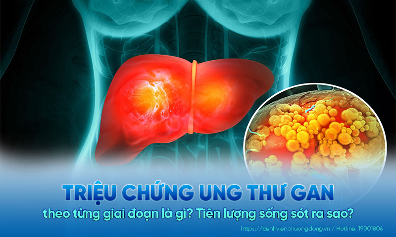 Triệu chứng ung thư gan giai đoạn đầu, giai đoạn cuối là gì? Tiên lượng sống sót ra sao?