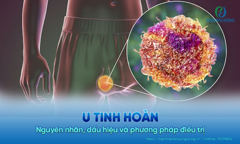 U tinh hoàn: Nguyên nhân, dấu hiệu và phương pháp điều trị