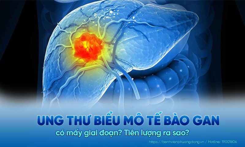 Ung thư biểu mô tế bào gan có mấy giai đoạn? Tiên lượng ra sao?