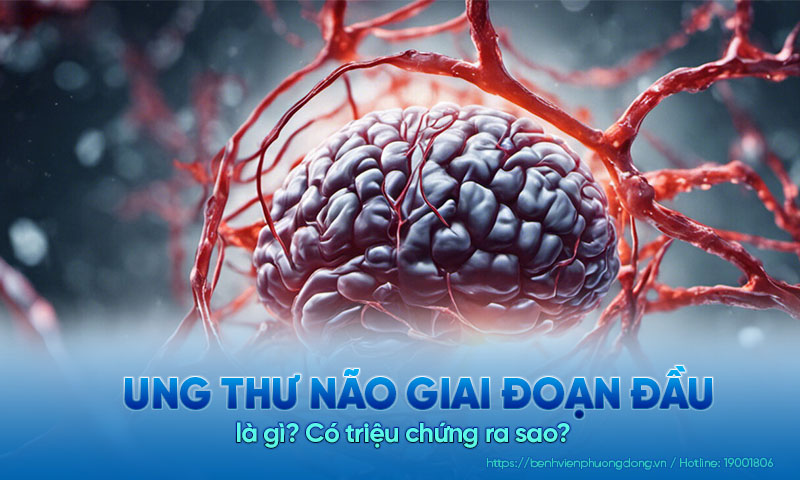 Ung thư não giai đoạn đầu là gì? Có triệu chứng ra sao?