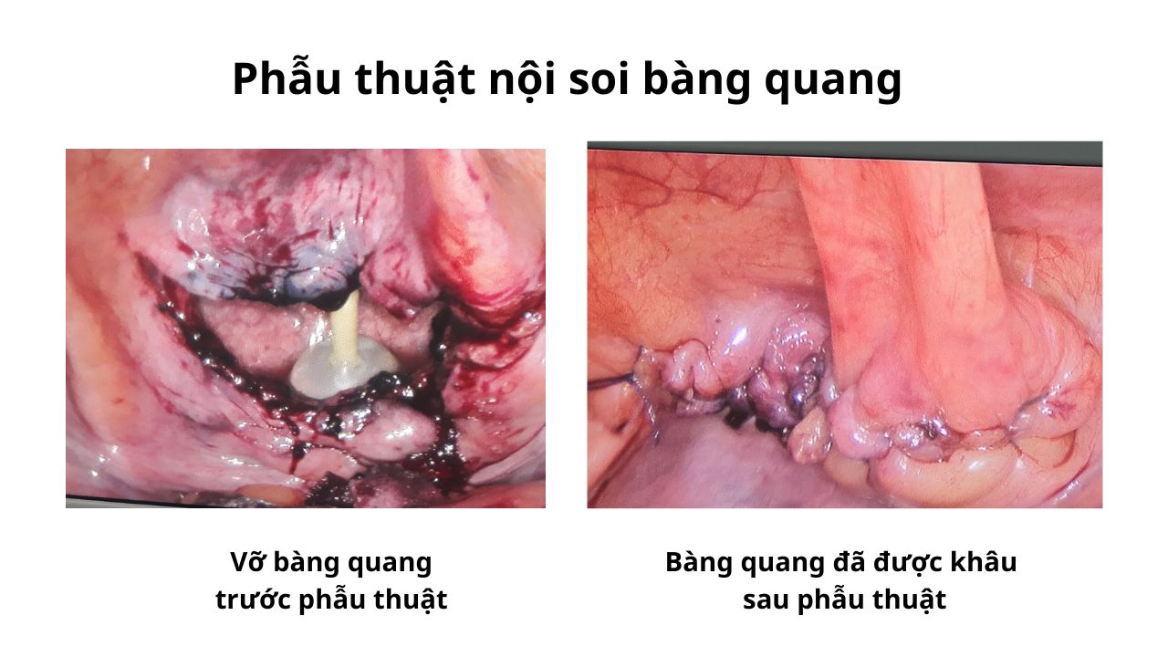 Hình ảnh bàng quang bị vỡ trước và sau khi phẫu thuật nội soi (Nguồn: Sưu tầm)