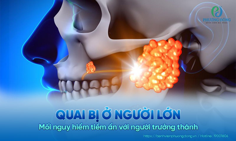 Quai bị ở người lớn: Mối nguy hiểm tiềm ẩn với người trưởng thành