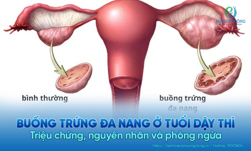 Buồng trứng đa nang ở tuổi dậy thì: Triệu chứng, nguyên nhân và phòng ngừa