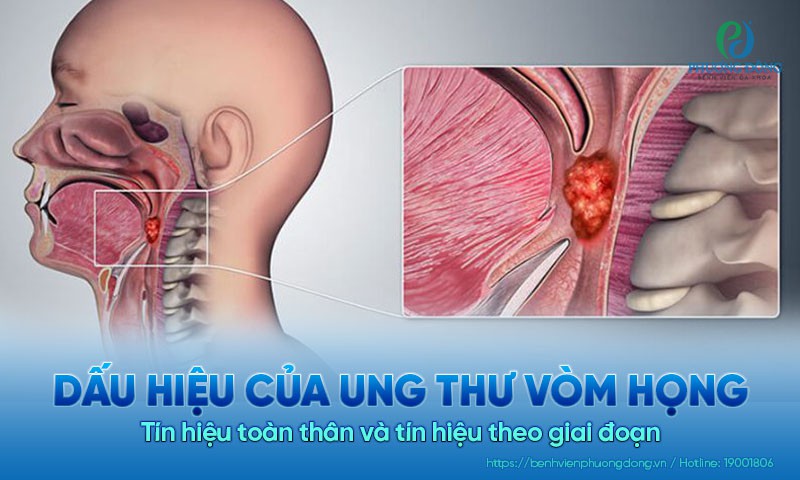 Dấu hiệu của ung thư vòm họng không thể bỏ qua