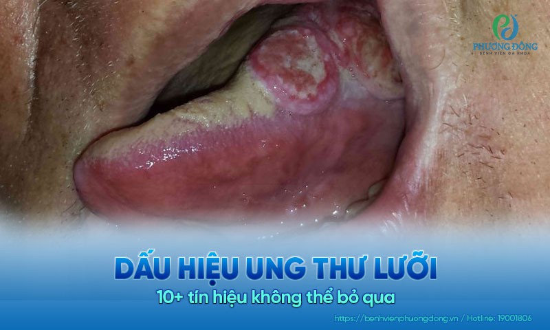 10+ dấu hiệu ung thư lưỡi không thể chủ quan