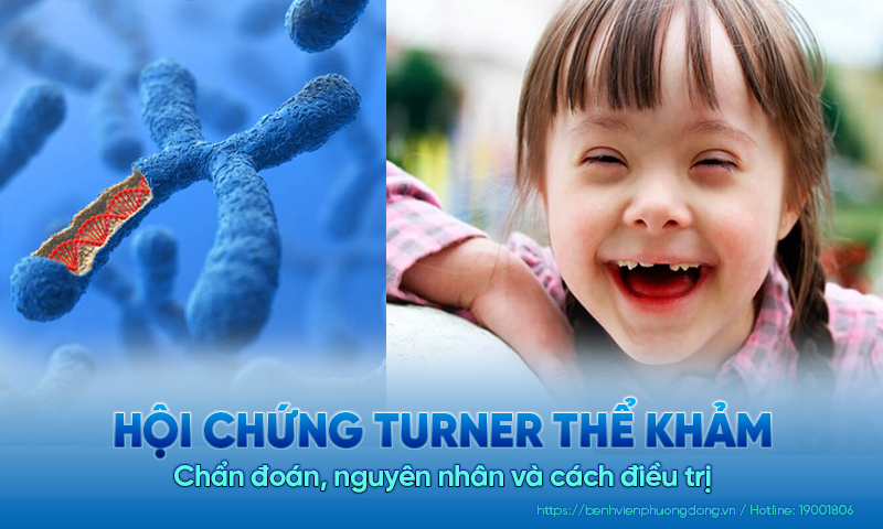 Hội chứng Turner thể khảm: Chẩn đoán, nguyên nhân và điều trị