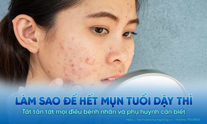 Làm sao để hết mụn tuổi dậy thì? Tất tần tật mọi điều bệnh nhân và phụ huynh cần biết