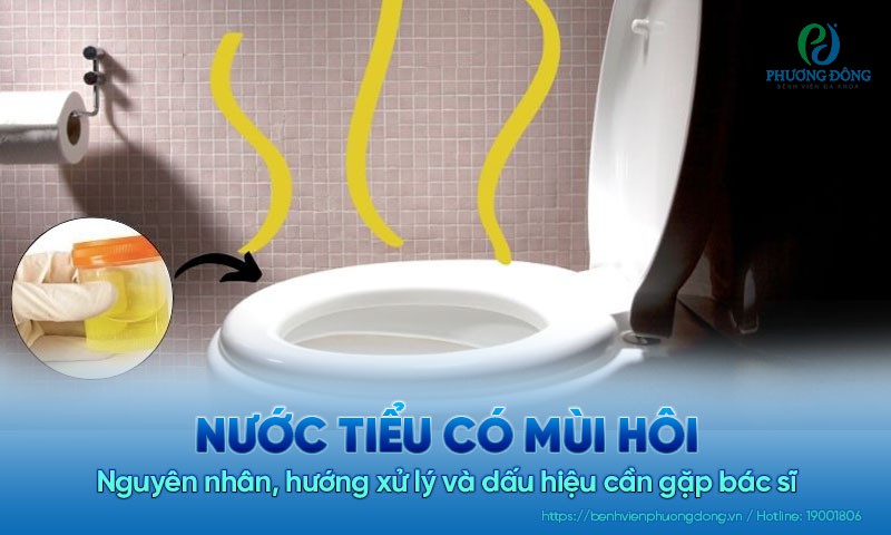 Nước tiểu có mùi hôi: Nguyên nhân, hướng xử lý và dấu hiệu cần gặp bác sĩ