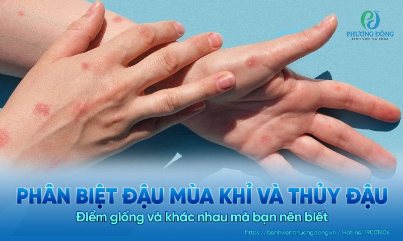 Hướng dẫn cách phân biệt đậu mùa khỉ và thủy đậu