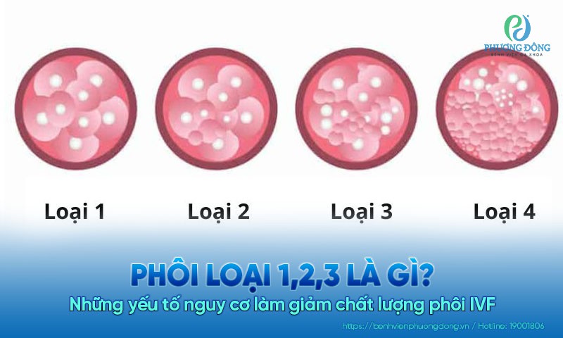 Phôi loại 1,2,3 là gì? Những yếu tố nguy cơ làm giảm chất lượng phôi IVF