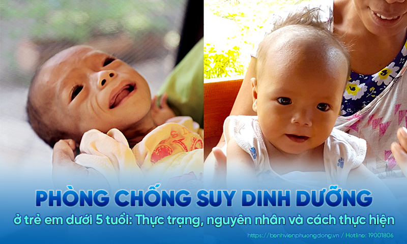 Phòng chống suy dinh dưỡng ở trẻ em dưới 5 tuổi: Thực trạng, nguyên nhân và cách thực hiện