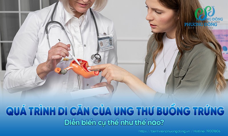 Quá trình di căn của ung thư buồng trứng: Diễn biến như thế nào?