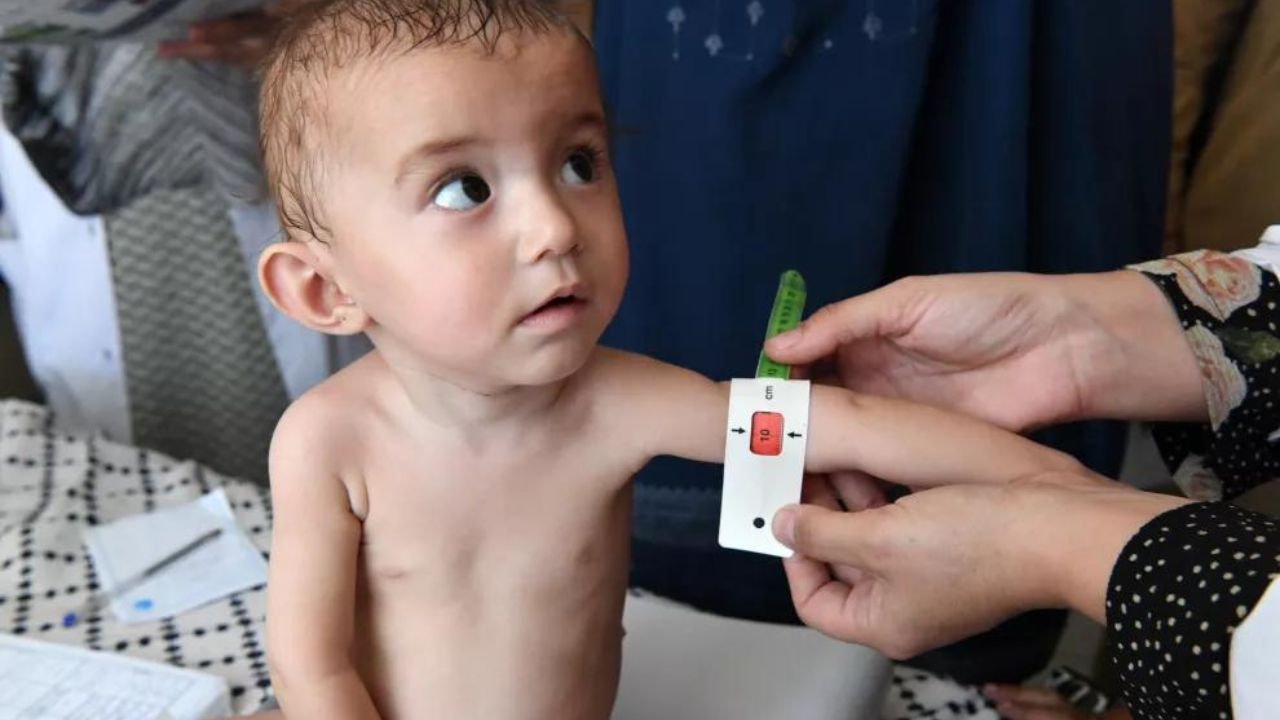 Trẻ em bị suy dinh dưỡng gầy còm chậm lớn, thấp bé&nbsp;