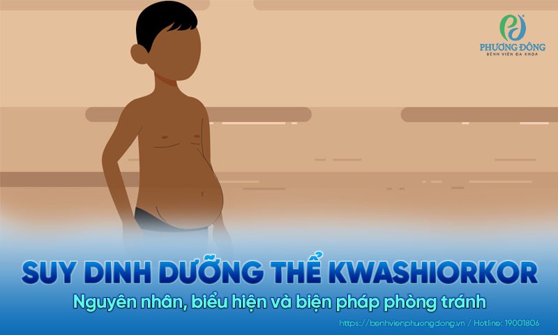 Tìm hiểu về suy dinh dưỡng thể Kwashiorkor ở trẻ