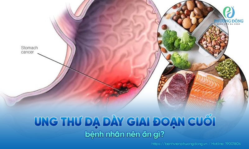 Ung thư dạ dày giai đoạn cuối nên ăn gì và kiêng ăn gì?