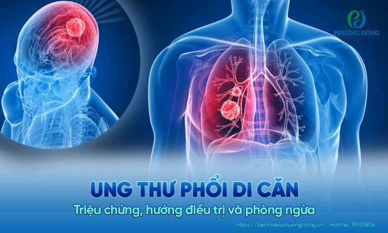 Ung thư phổi di căn: Triệu chứng, hướng điều trị và phòng ngừa