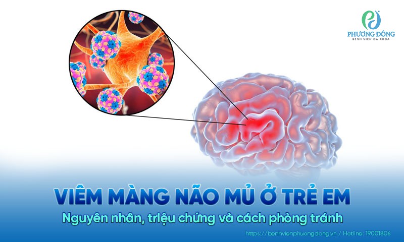 Viêm màng não mủ ở trẻ em: Nguyên nhân, triệu chứng và cách phòng tránh