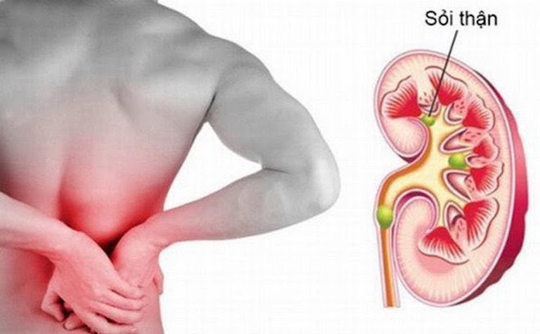 Cơ chế tác dụng của Kim tiền thảo trong điều trị sỏi thận