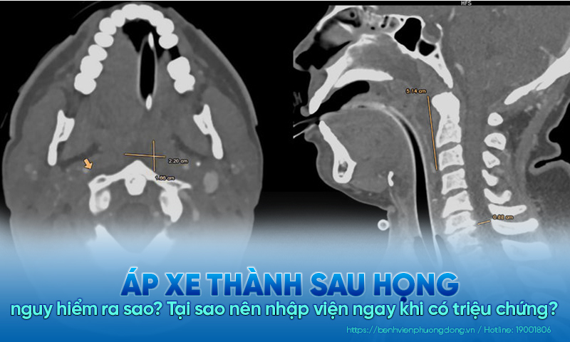 Áp xe thành sau họng nguy hiểm ra sao? Tại sao nên nhập viện ngay khi có triệu chứng?