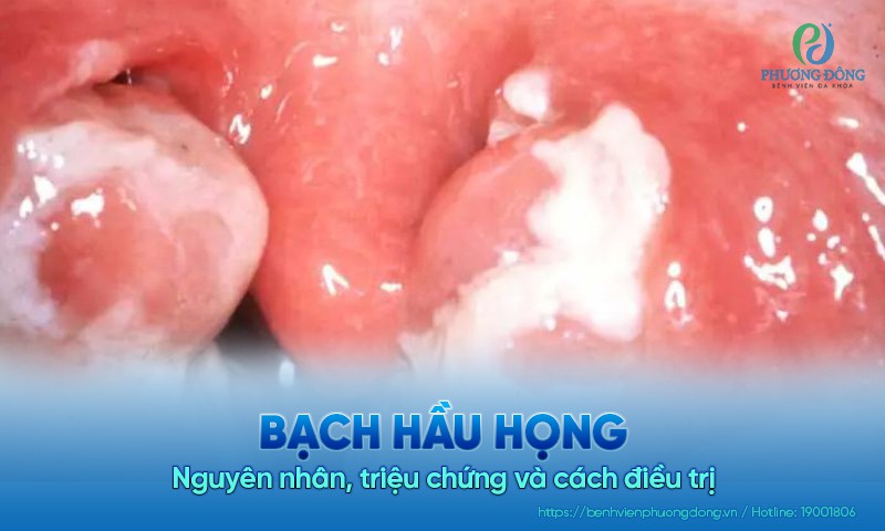 Bạch hầu họng: Nguyên nhân, triệu chứng và cách điều trị