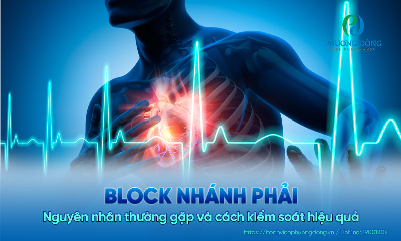 Block nhánh phải: Nguyên nhân thường gặp và cách kiểm soát hiệu quả