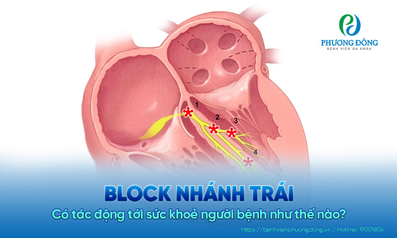 Block nhánh trái là gì? Có tác động tới sức khỏe người bệnh như thế nào?