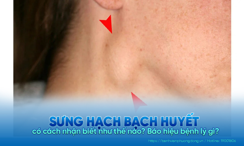 Cách nhận biết sưng hạch bạch huyết là gì? Báo hiệu bệnh lý gì?