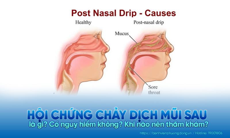 Hội chứng chảy dịch mũi sau là gì? Có nguy hiểm không? Khi nào nên thăm khám?