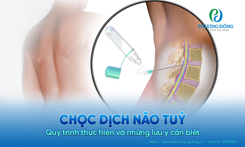 Chọc dịch não tuỷ: Quy trình thực hiện và những lưu ý bạn cần biết